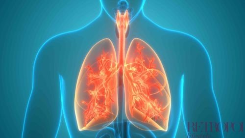 lung cancer
